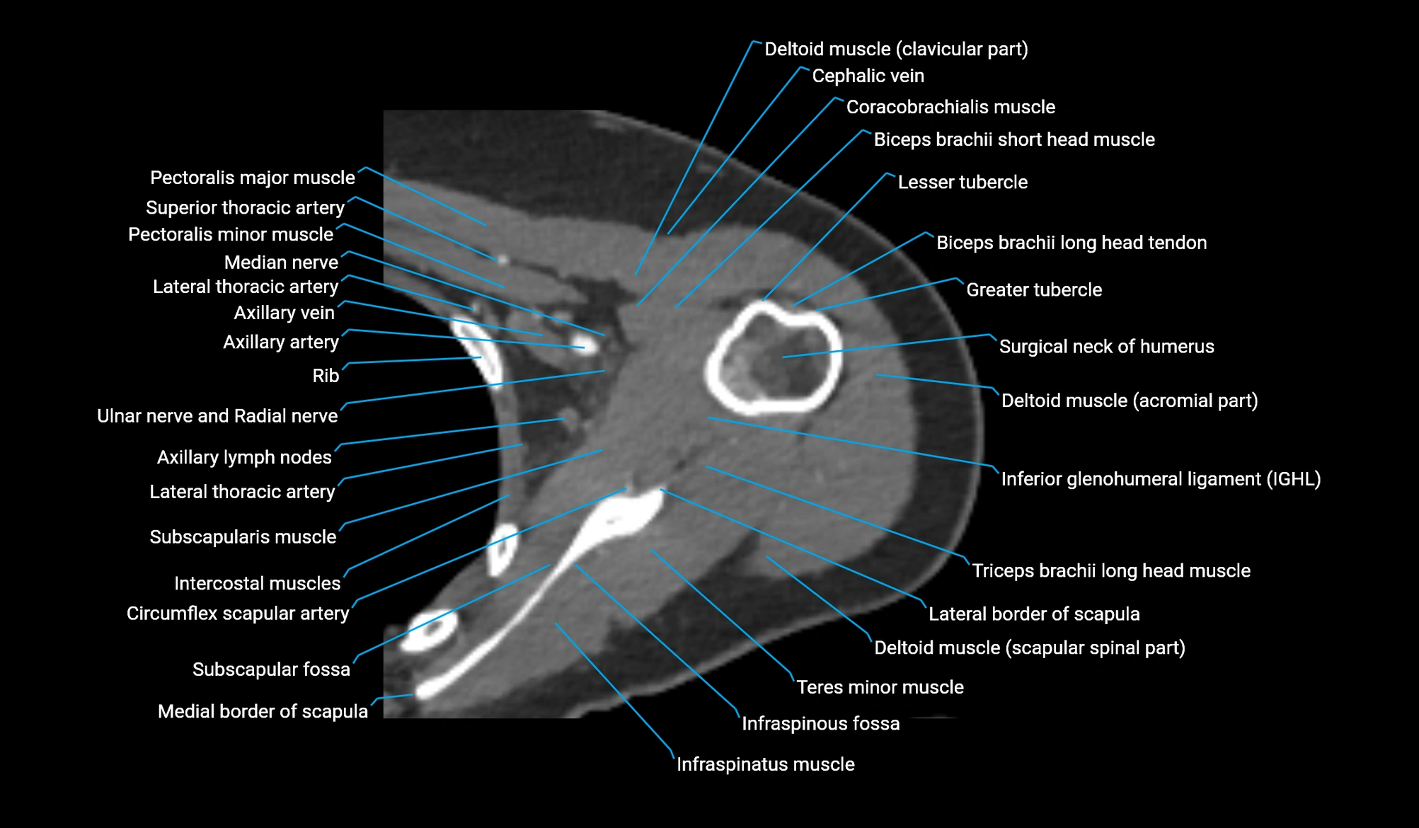 CT upper arm axial  cross sectional anatomy labelled radiology image -00114.webp